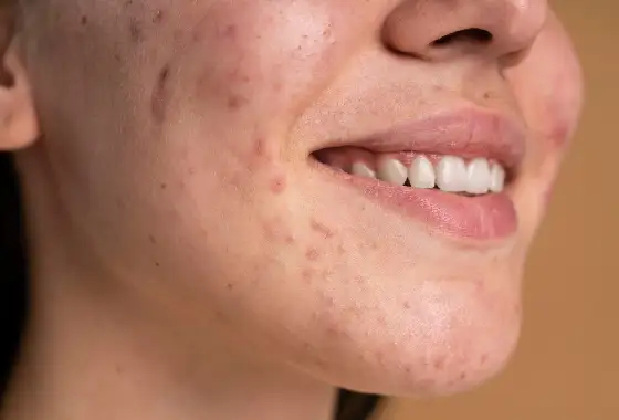 Acne Scars Acne Scars
